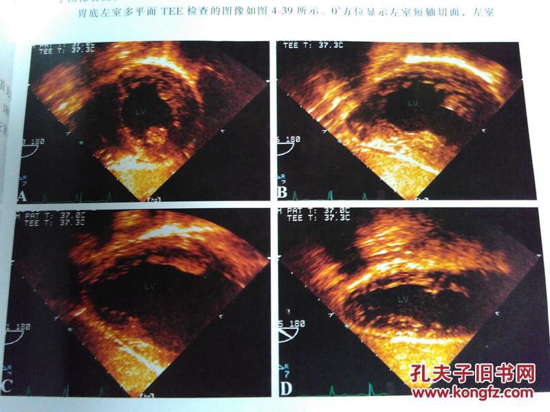 介绍了经食管超声心动图的技术原理检查方法,断面解剖和正常图像,经