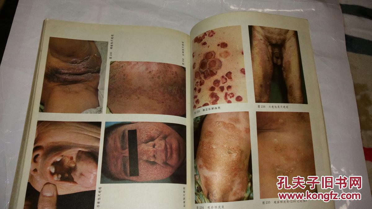 常见皮肤病彩色图谱