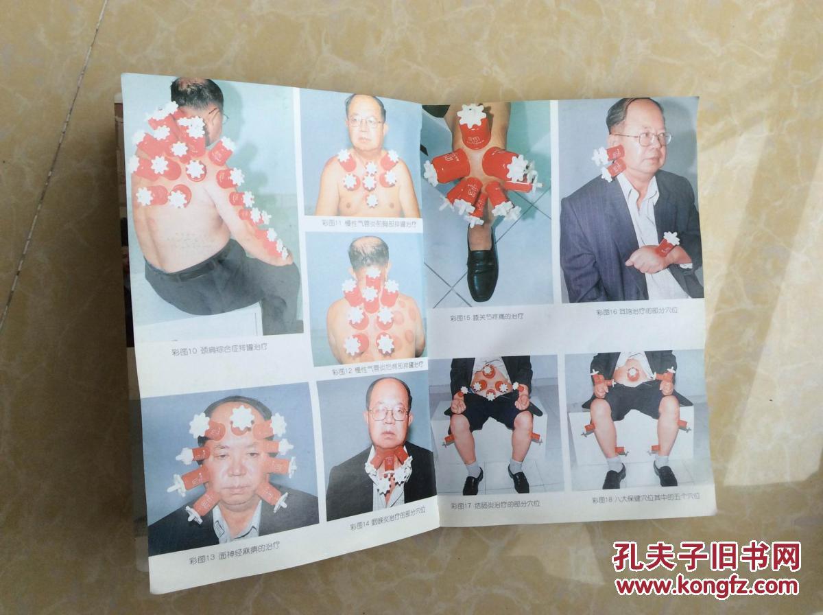 中医类孟氏中药拔罐疗法