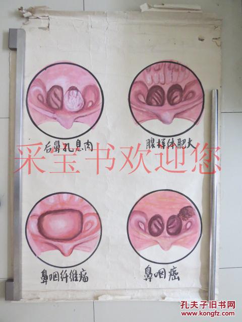 挂图 后鼻孔息肉 腺样体肥大 鼻咽纤维瘤 鼻咽癌