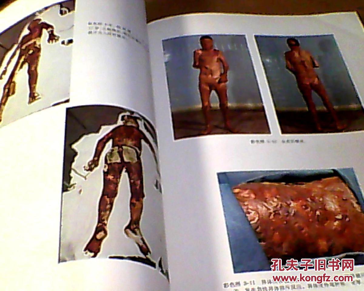 【图】烧伤治疗【上海第二医疗学院附属瑞金医院烧伤科编、75年1版1印】_价格:28.00_网上书店网站_孔夫子旧书网