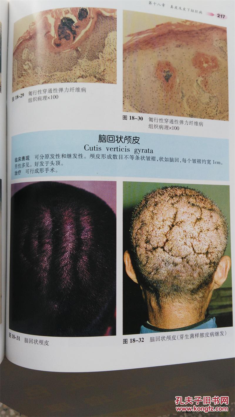 实用皮肤病性病彩色图谱