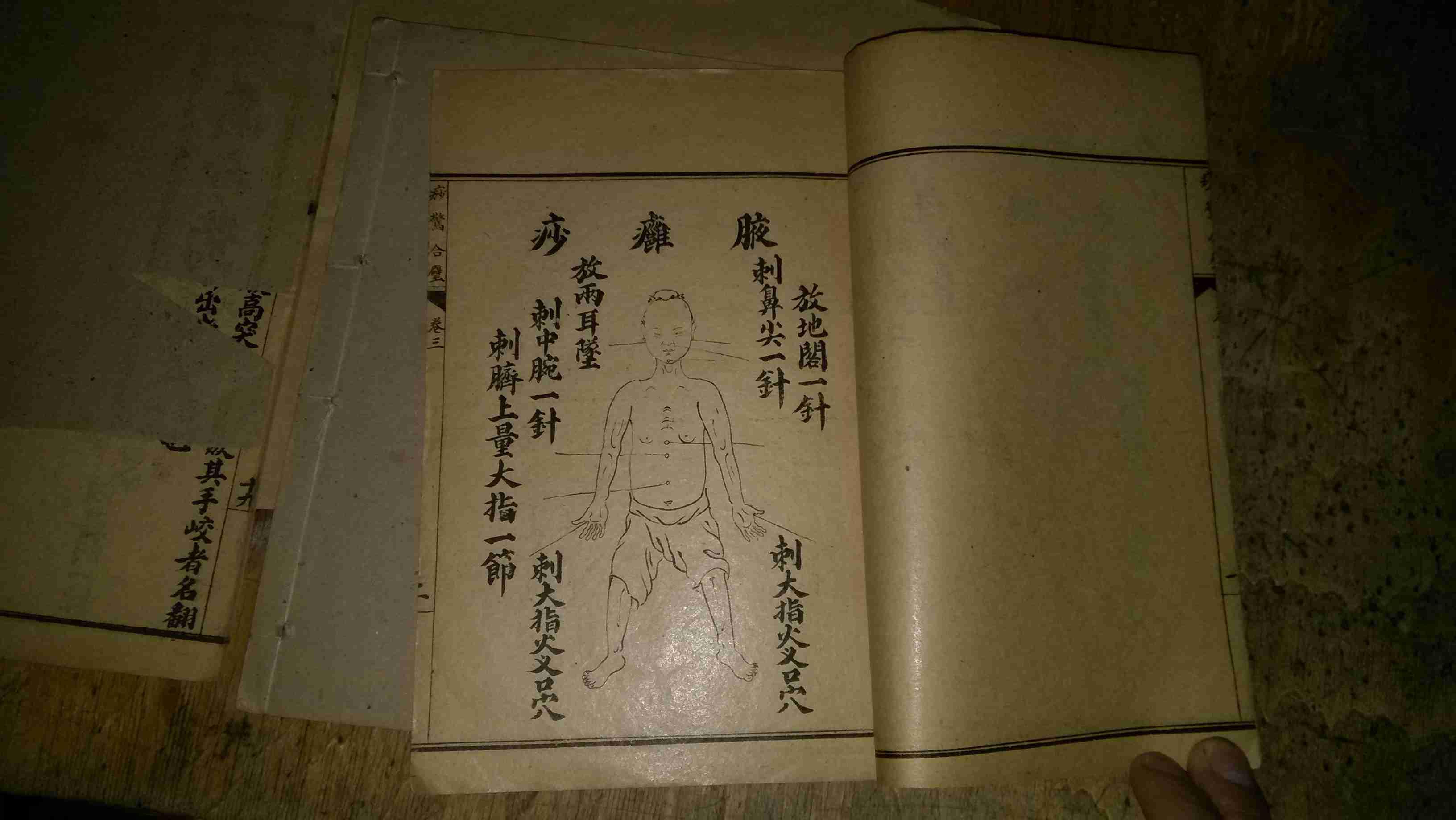 绘图痧惊合璧 卷一至卷三(1-3册全图)民国6年上海鸿文书局印行