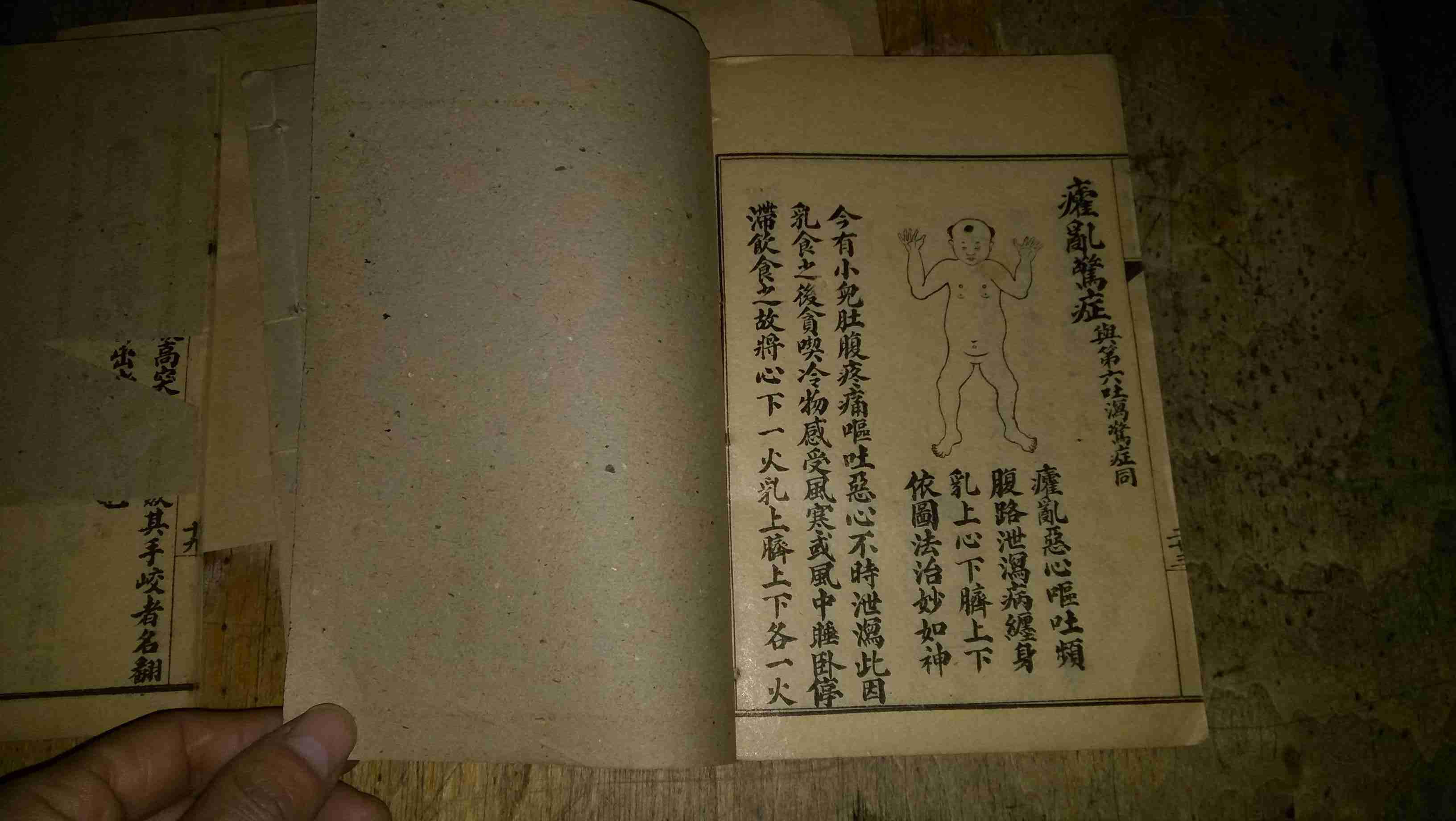 绘图痧惊合璧 卷一至卷三(1-3册全图)民国6年上海鸿文书局印行