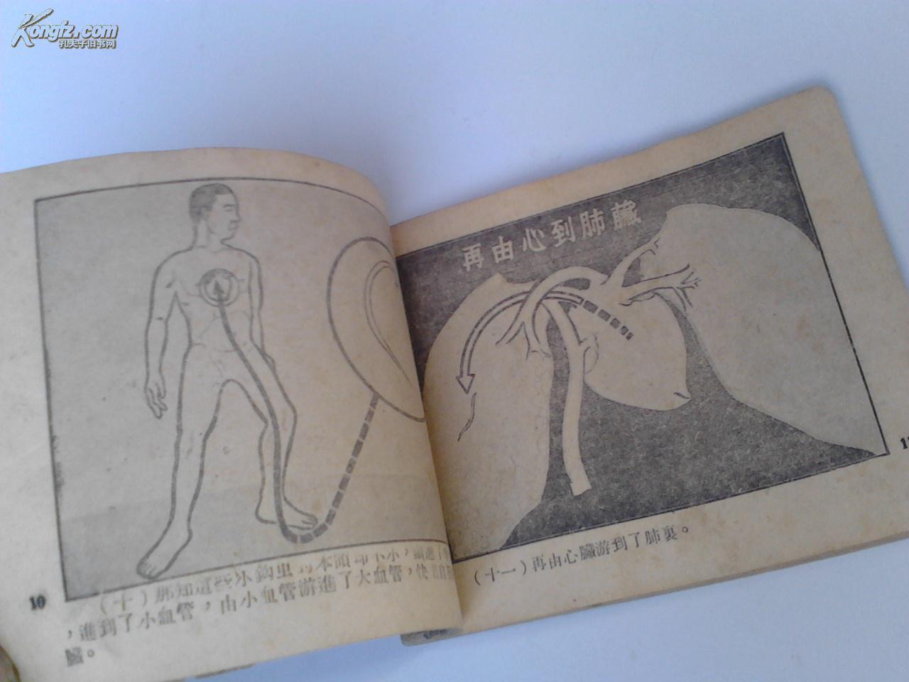 钩虫病 