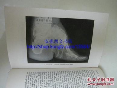 《中国缠足》---- 20多整页图片,中国现状,风俗,x光透视缠足/裹足照片
