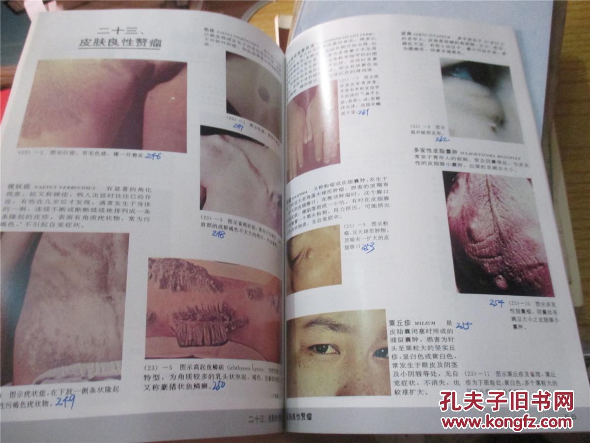 皮肤病性病识别彩图(彩图.