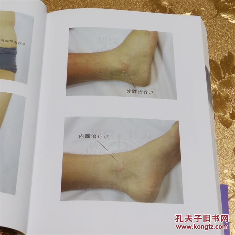 超微针刀疗法:运动医学的浅筯膜松解术胡超伟 著 湖北