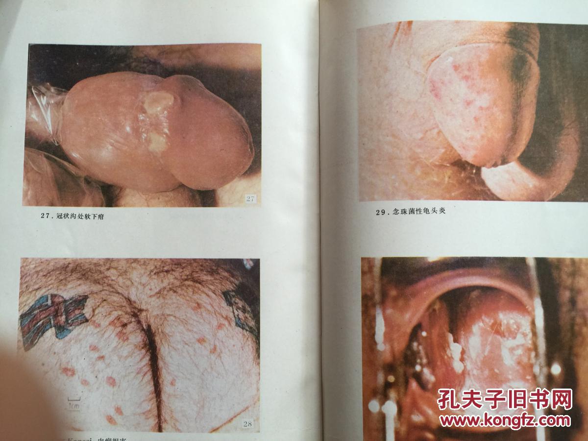 性传播疾病