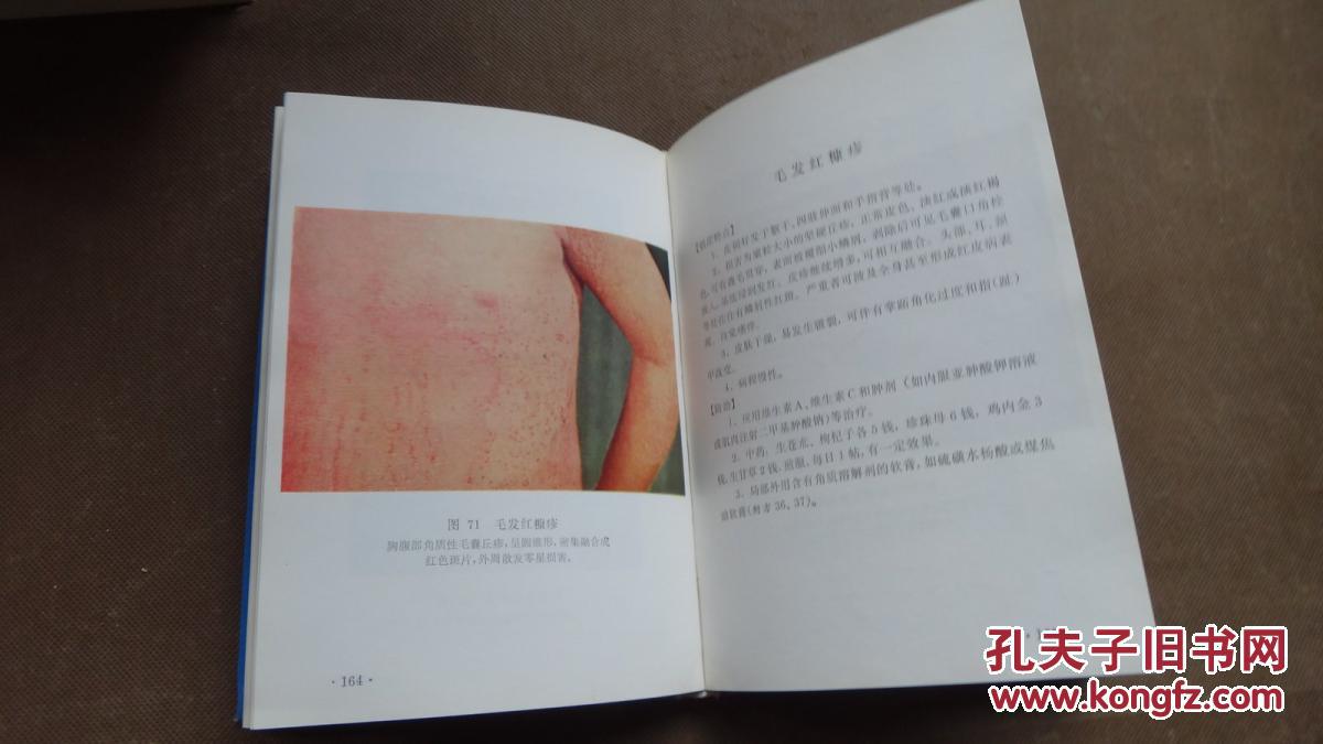 常见皮肤病图谱