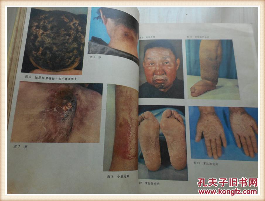 常见皮肤病彩色图谱