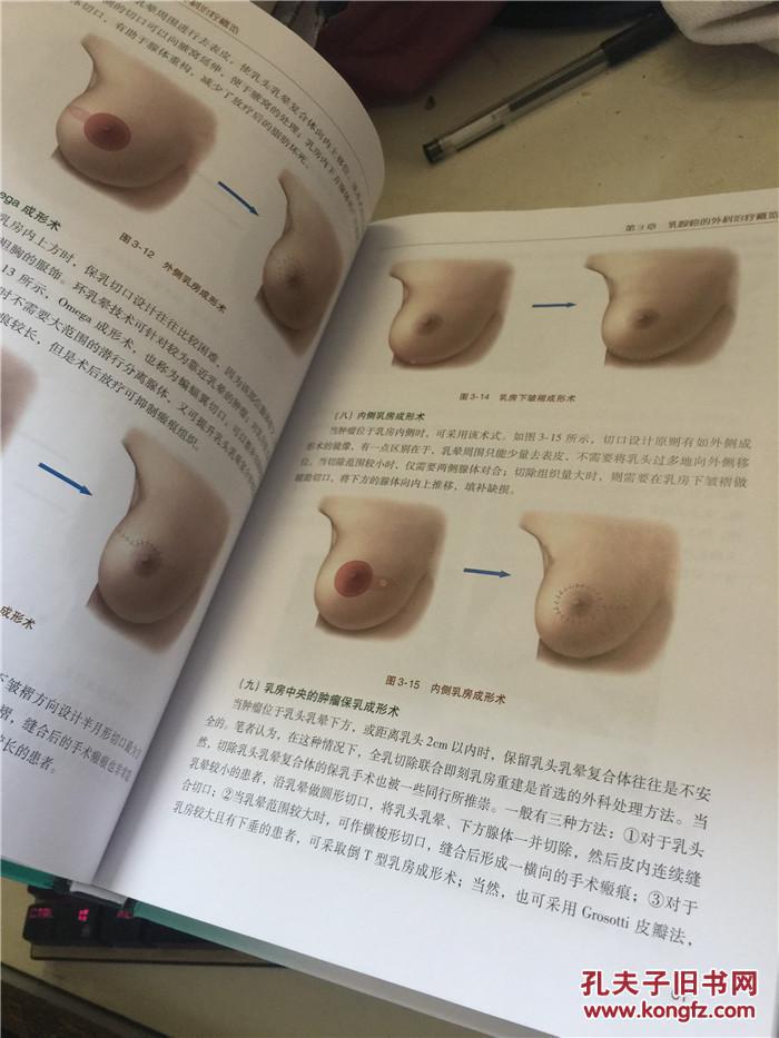 乳腺癌术后乳房重建 正版现货