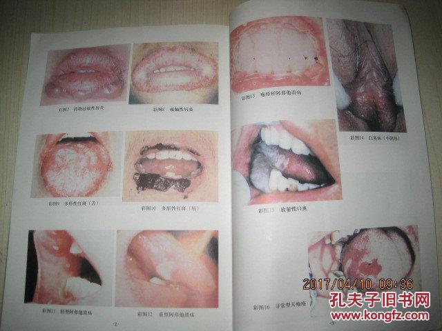 口腔粘膜红肿不痛图片_纵览新闻