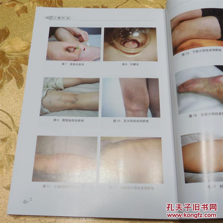 中医外治疗法简介 p4YBAFgFu52ARLo4AADzqzY0gds432_b.jpg