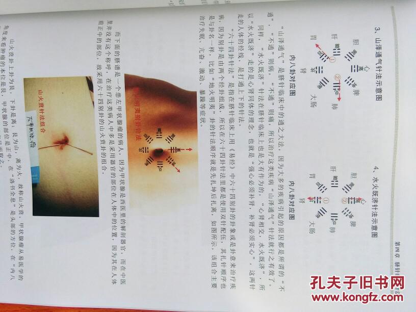 易医脐诊图谱解析—脐针疗法专著中国脐针鼻祖,易医大师—"脐针疗法"