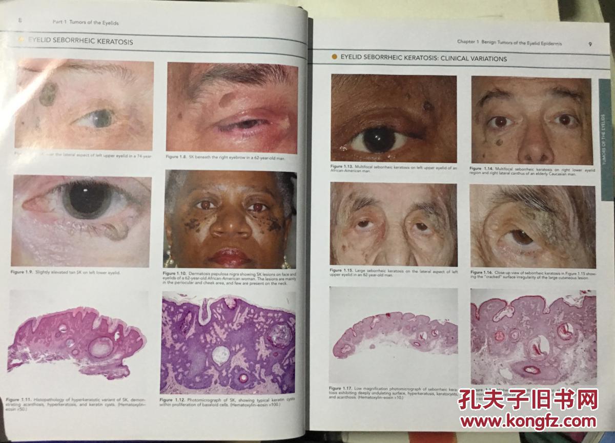 and orbital tumors: an atlas and textbook眼睑,结膜,眼眶肿瘤