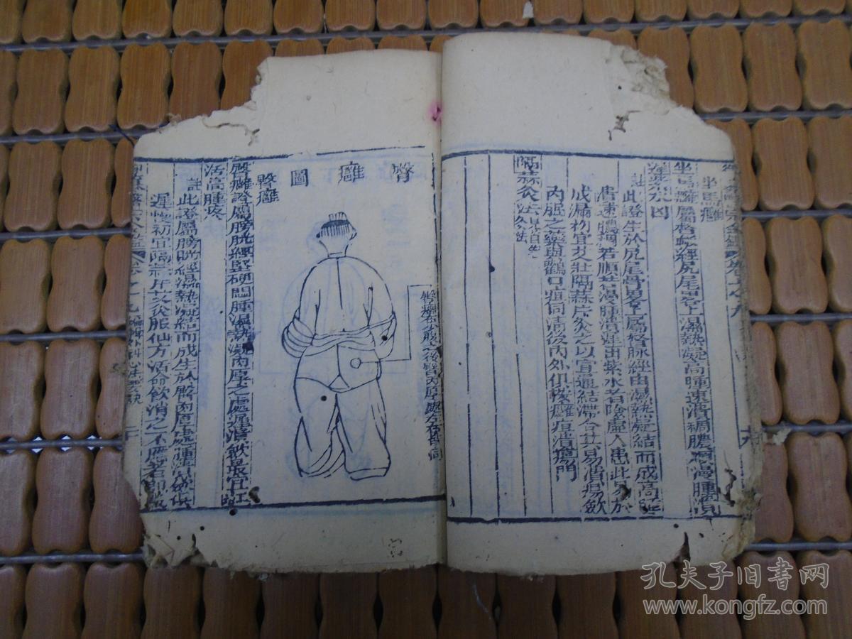 《御纂医宗金监》卷九卷十(编辑外科心法要诀:疳疮,妇人阴疮,鹳口疽