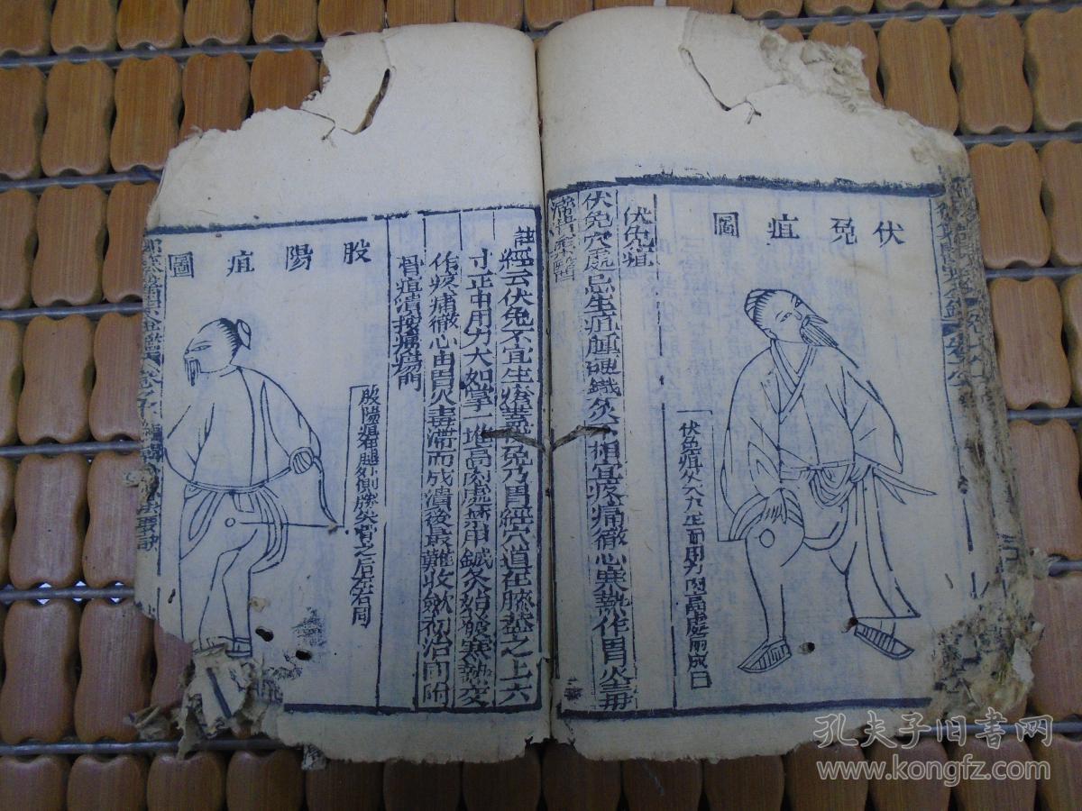 《御纂医宗金监》卷九卷十(编辑外科心法要诀:疳疮,妇人阴疮,鹳口疽