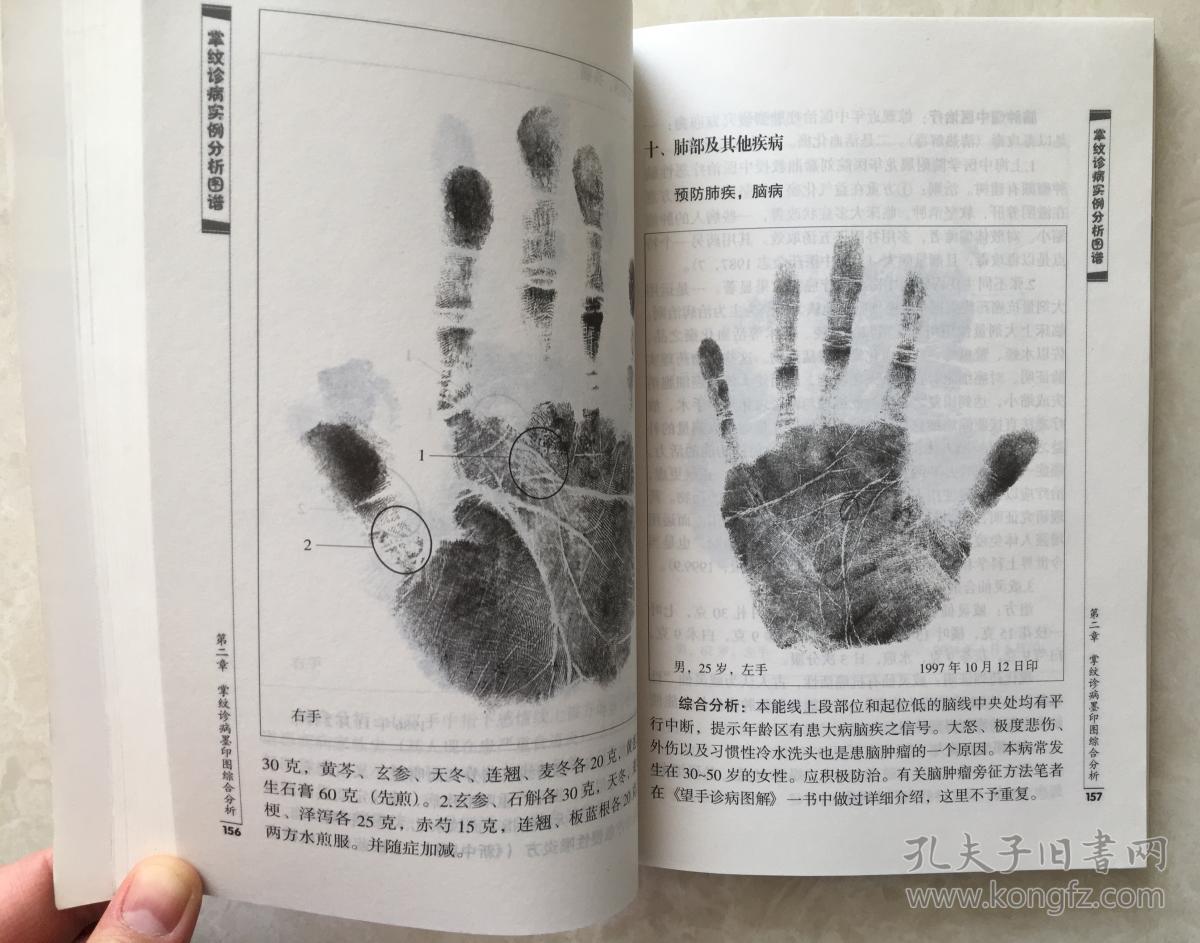 掌纹诊病实例分析图谱