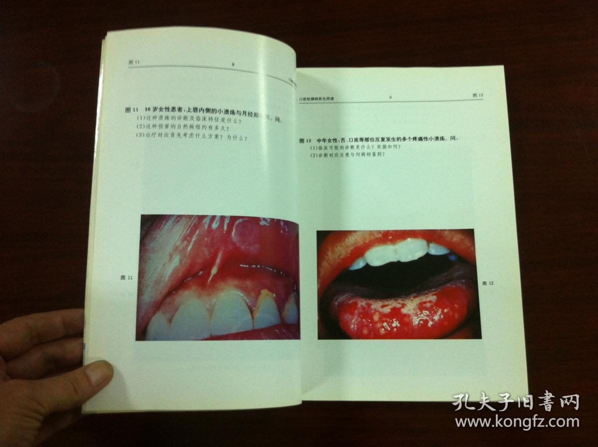 张文清主编《口腔粘膜病彩色图谱(全1册,北京医科大学 中国协和