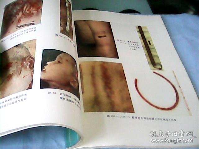 法医学机械性损伤图谱---存放南架二(1)