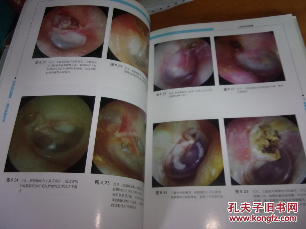 耳镜彩色图谱--从诊断到手术