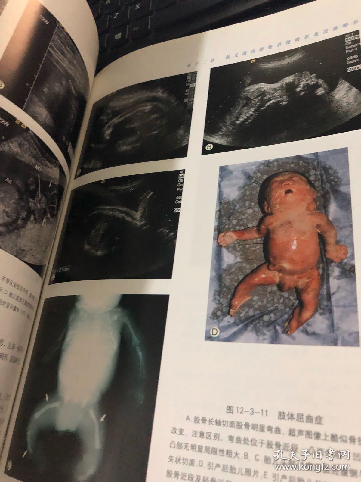 胎儿畸形产前超声诊断学 彩色