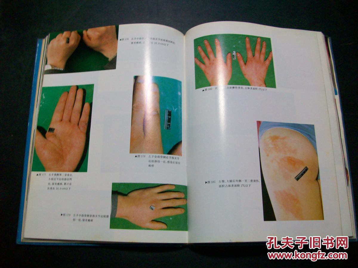法医学活体损伤图谱 b27-2