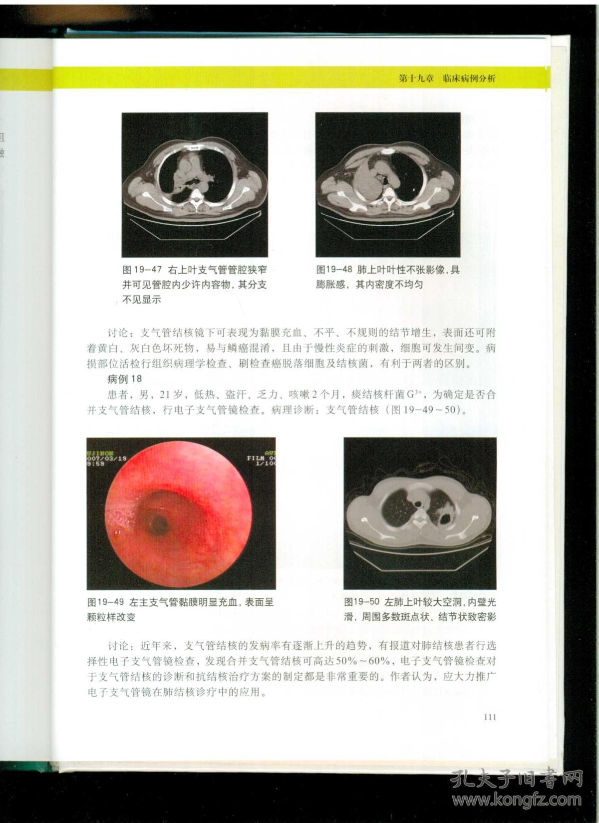 《电子支气管镜检查图谱》(16开硬精装 122页 铜版彩印图文本)九品