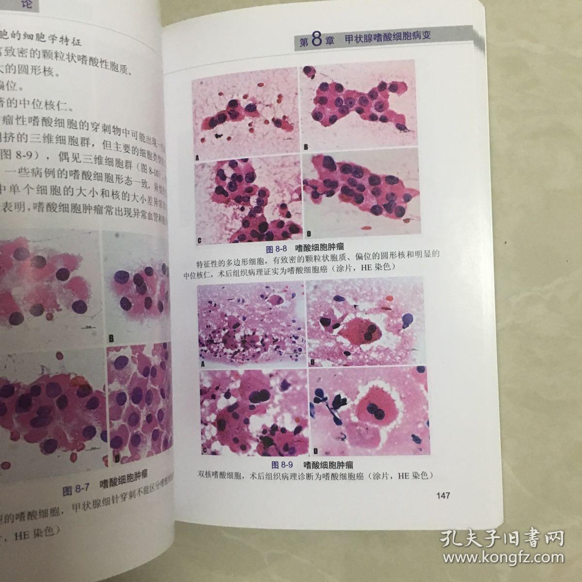 甲状腺细胞病理图谱