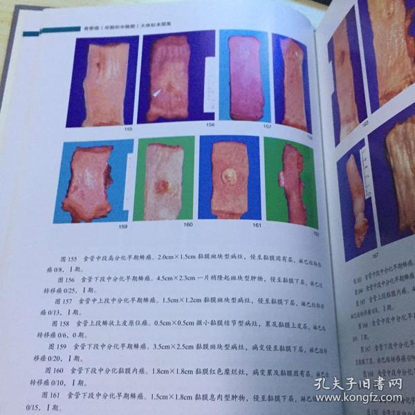 食管癌(早期和中晚期)大体标本图集