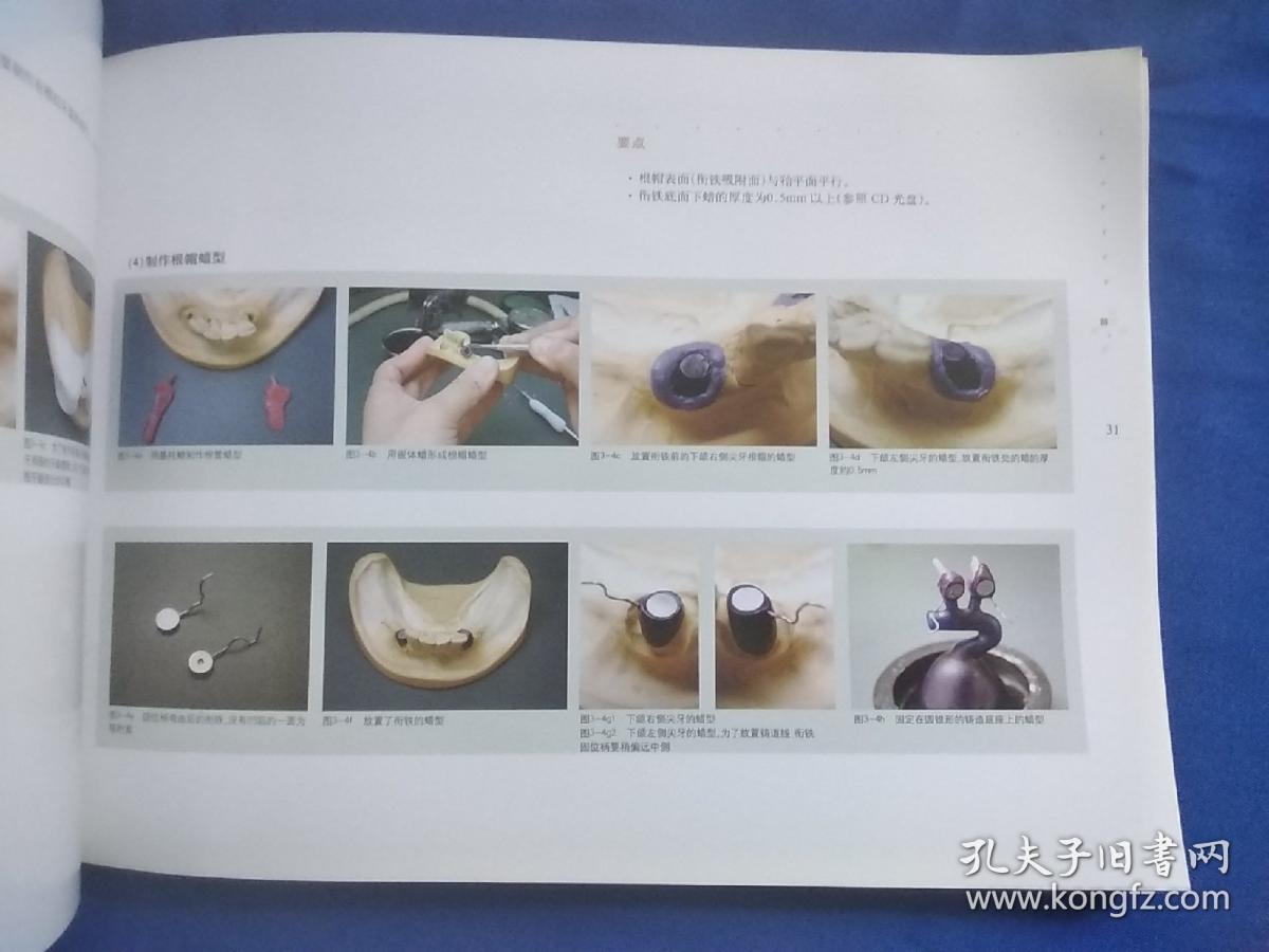 磁性附着体覆盖义齿的临床术式 附光盘
