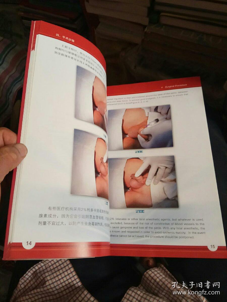 商环包皮环切术