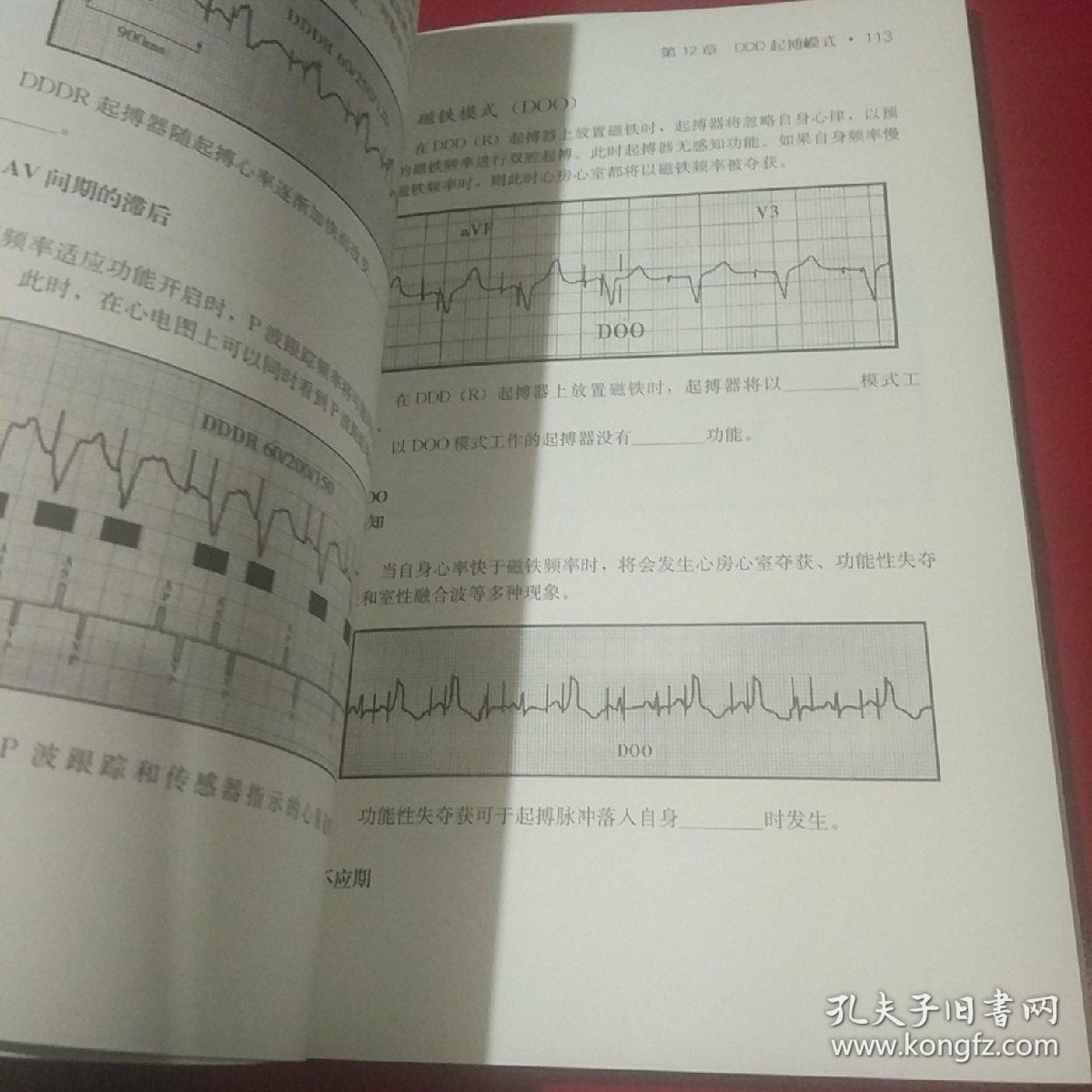 起搏器心电图简释