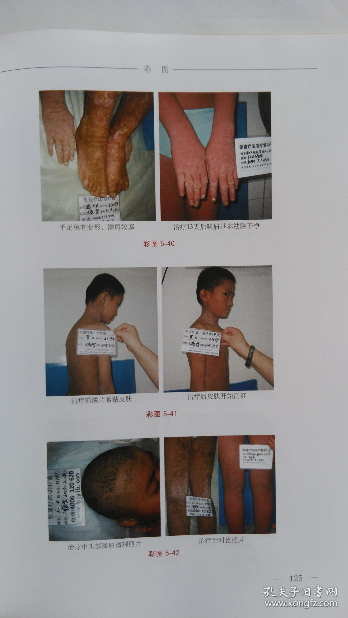 名中医张建治疗鱼鳞病