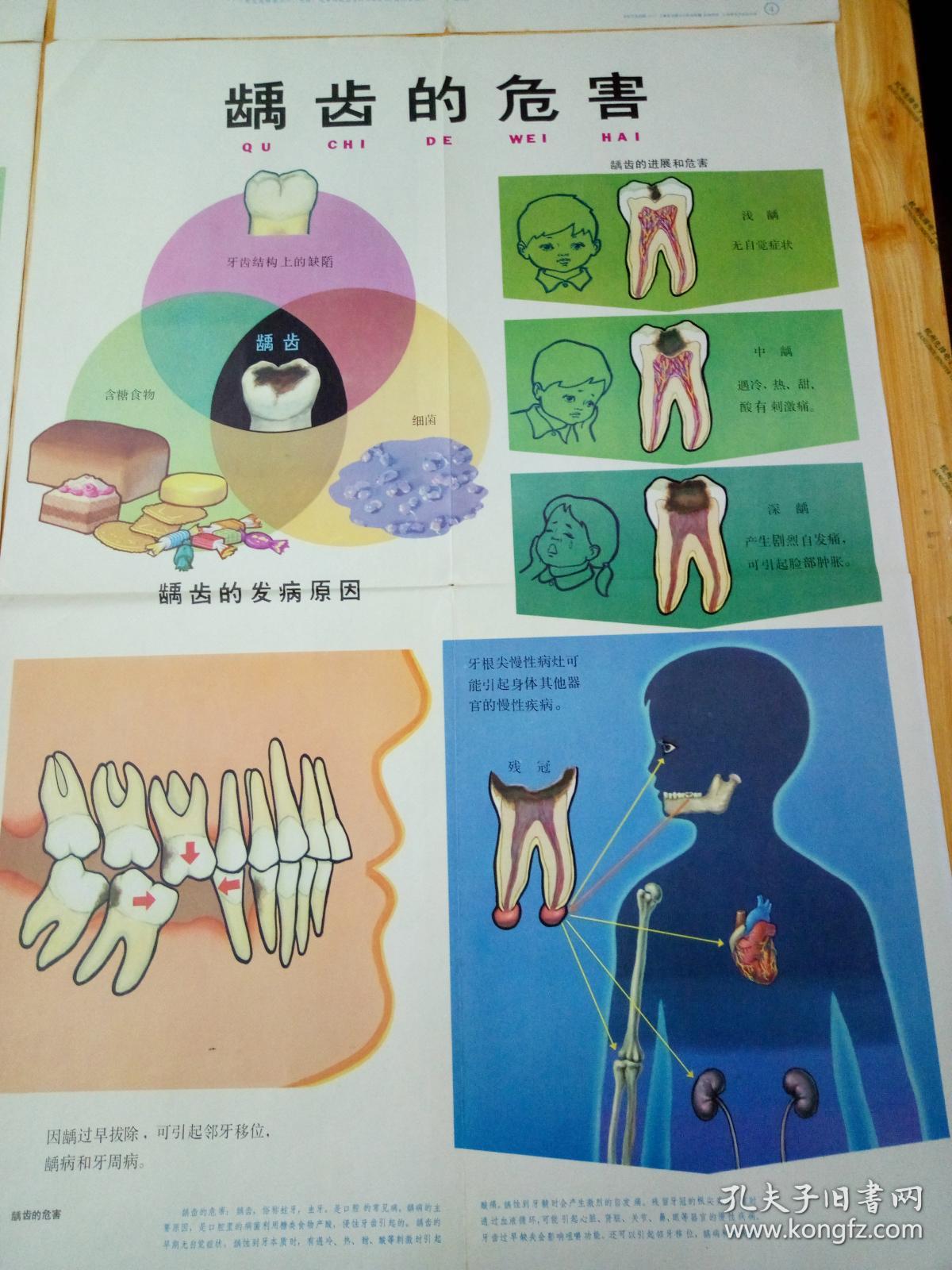 八十年代教学挂图,【龋齿的预防】,4张一起,品相好.