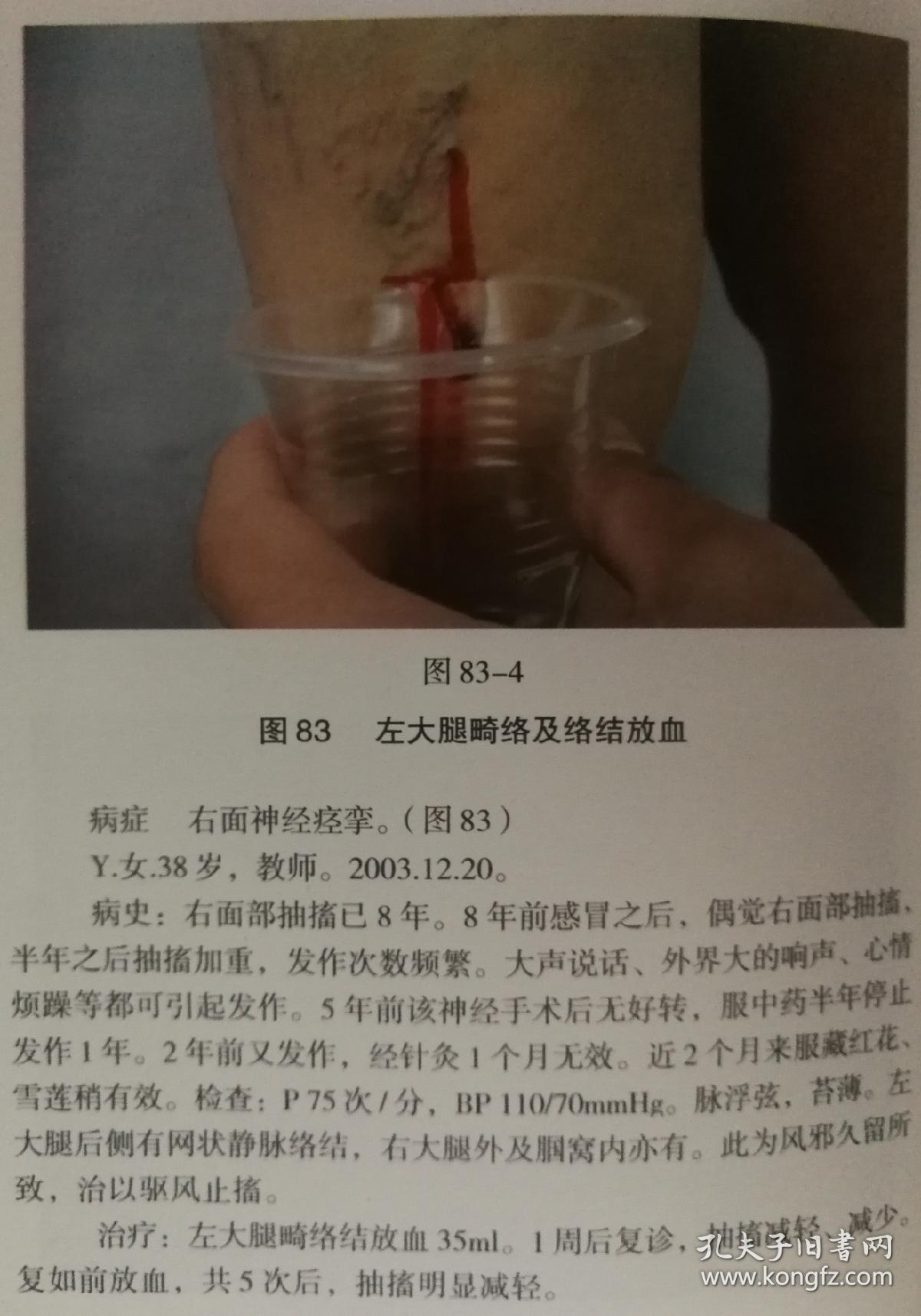 一版一印的,刺络放血名家俞喜春的《中华刺络放血图》