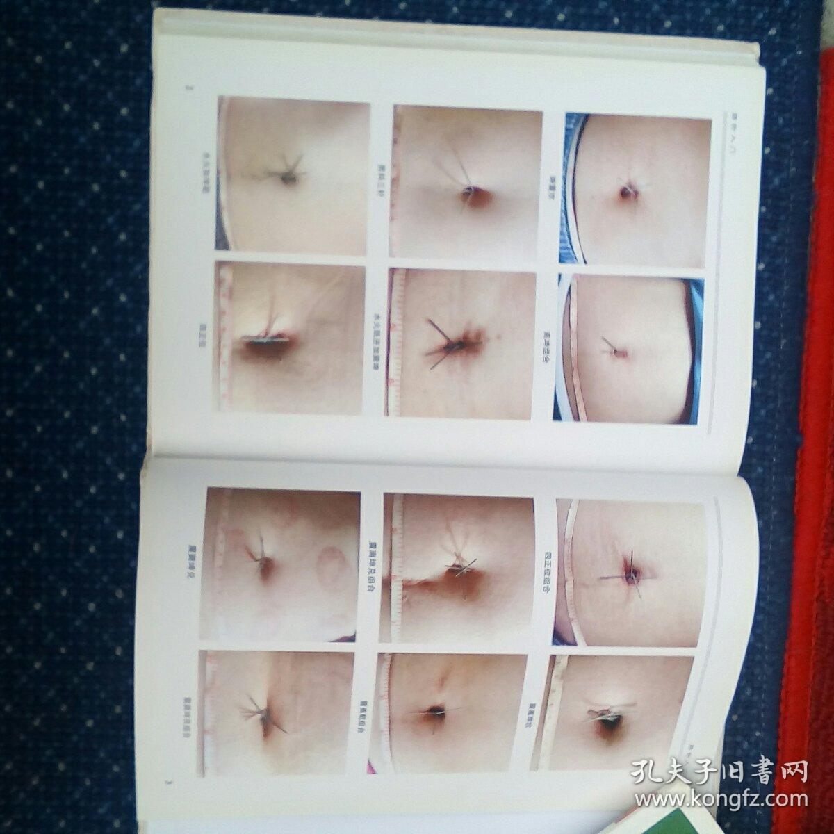 脐针入门