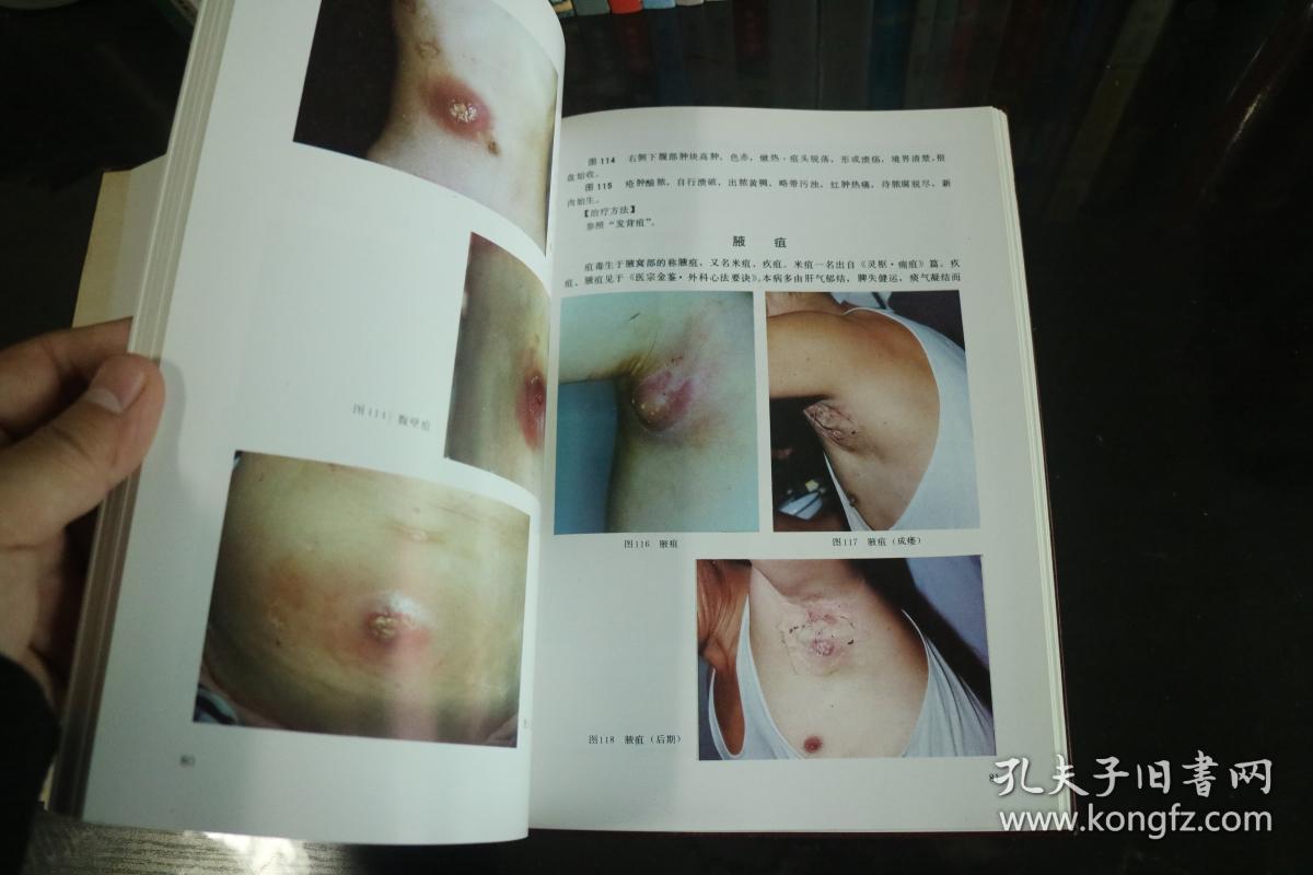 《疮疡图谱》全彩印,铜版纸印刷