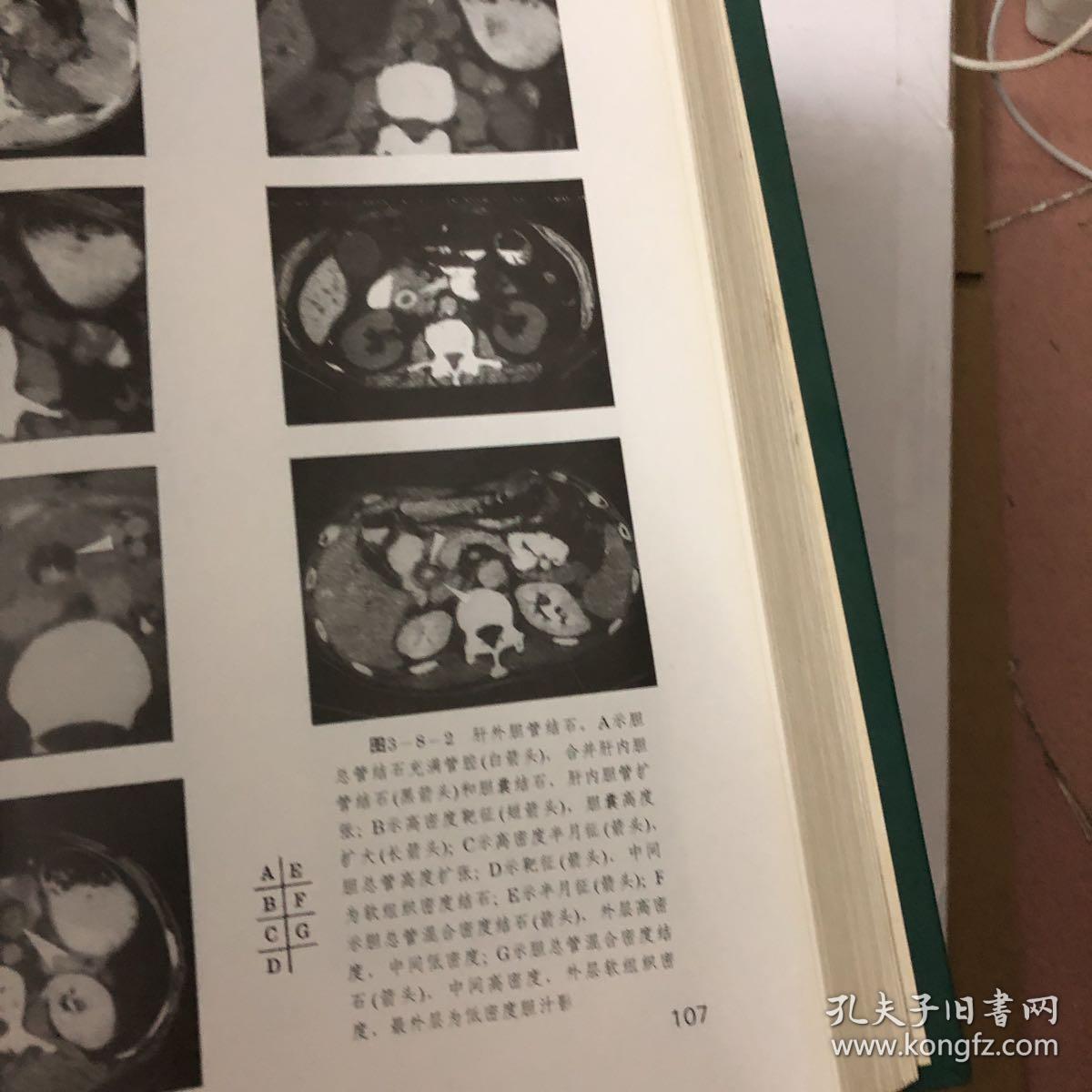 腹部ct 