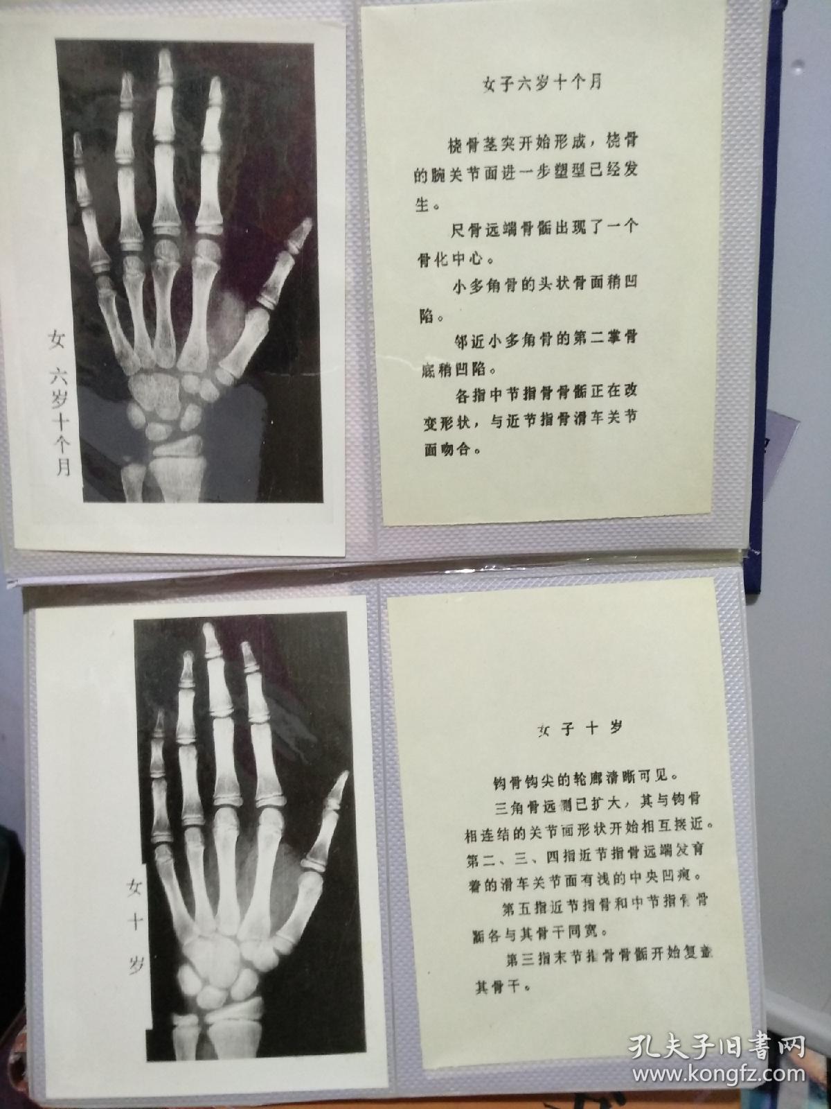 手腕关节骨龄图谱
