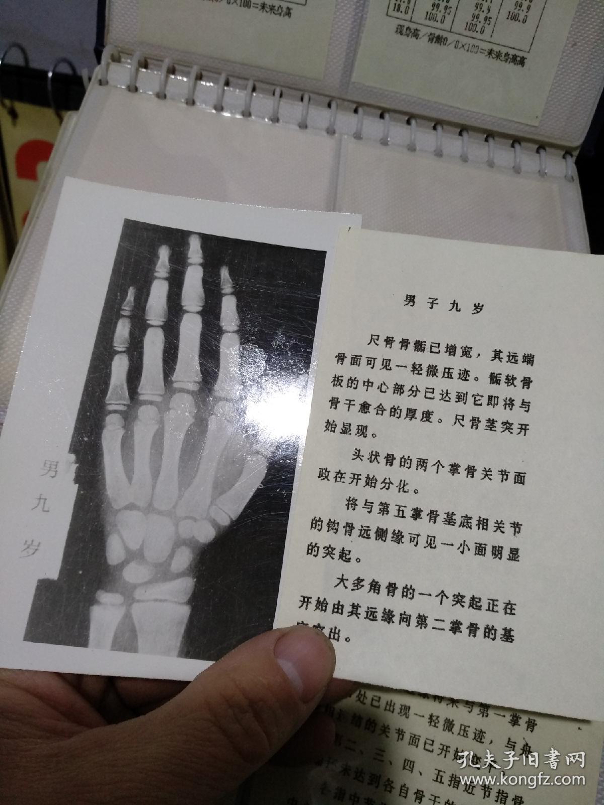 手腕关节骨龄图谱
