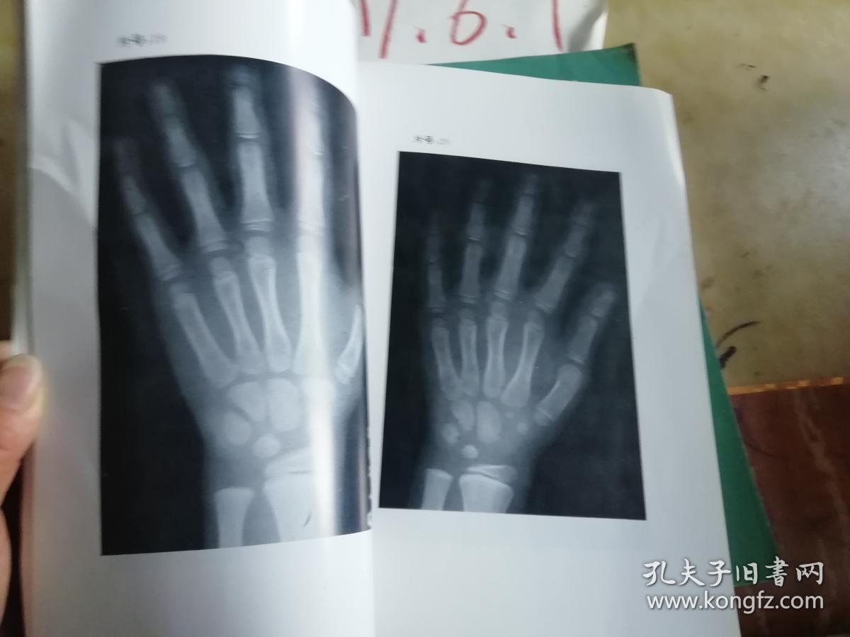中国人手腕骨发育标准----chn法 读片练习册