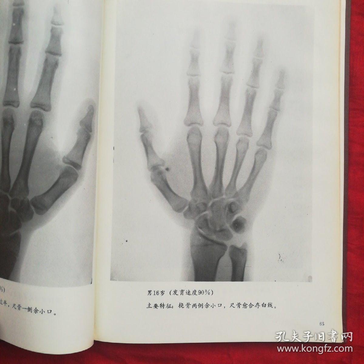 手腕部骨发育图谱
