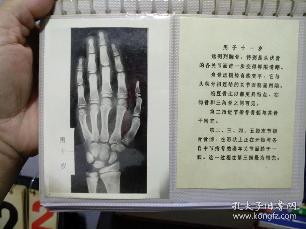 手腕关节骨龄图谱