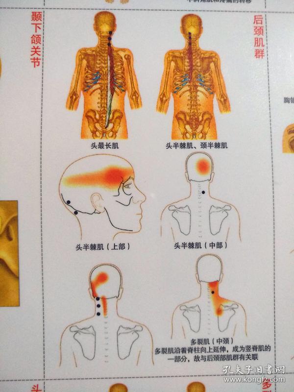 激痛点疗法(三张彩色图加一本教材书)