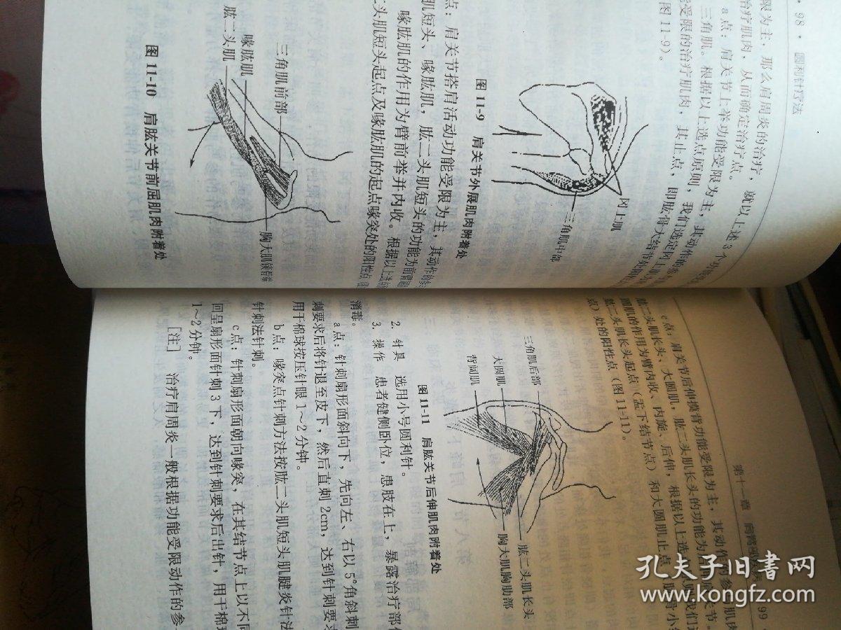 圆利针疗法:运动损伤中西医结合针灸疗法_胡超伟 著