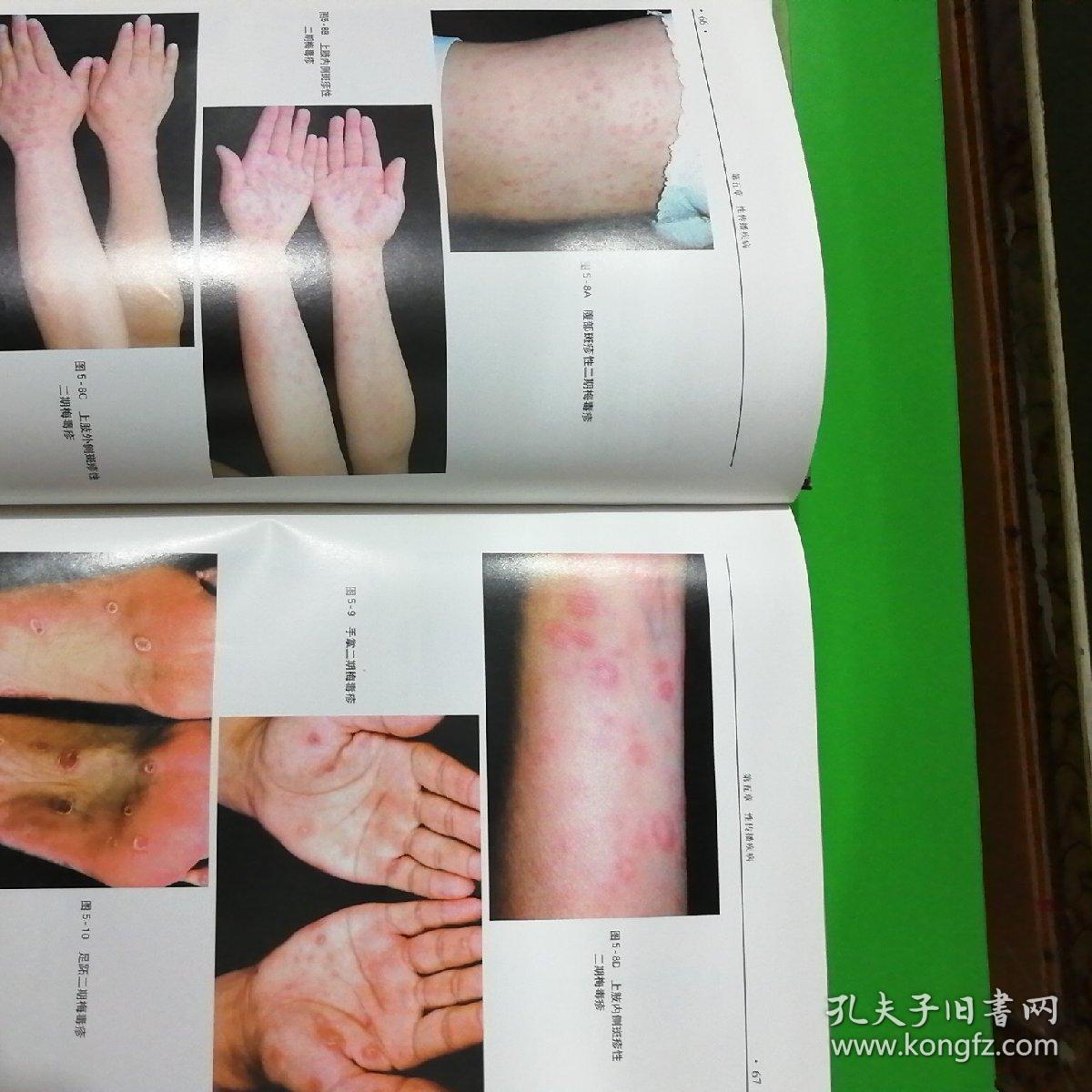 临床皮肤病性病彩色图谱