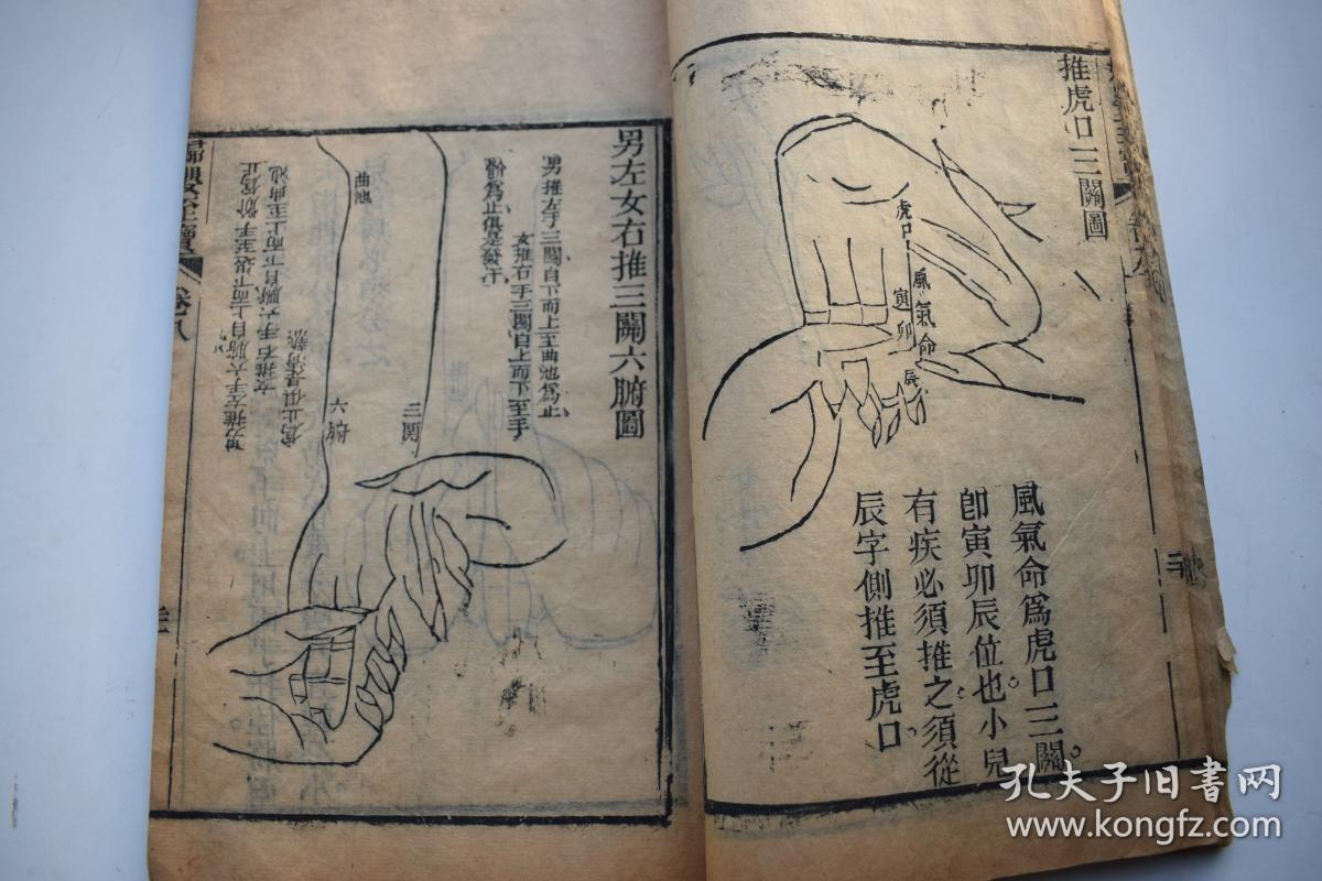 原装一册,卷八有大量图版:正面诸穴图,阳掌图,阴掌图,正面全身图,男左