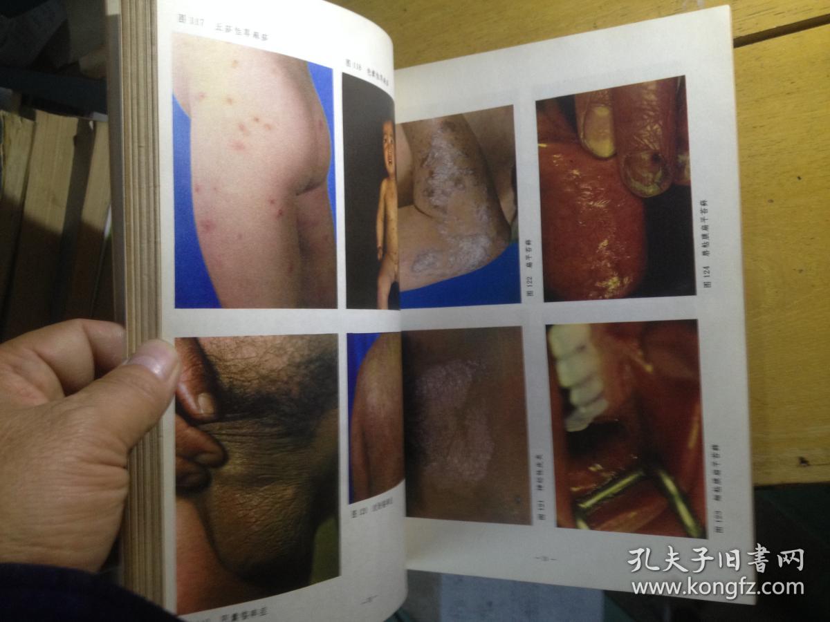 常见皮肤病彩色图谱